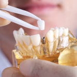 Cost of Dental Implant Mumbai
